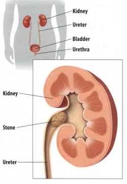 Kidney_Stone