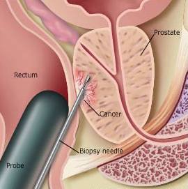 prostate_biopsy