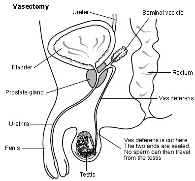 vasectomy diagram showing where the vas deferens is cut