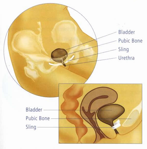 vaginalsling diagram for bladder support